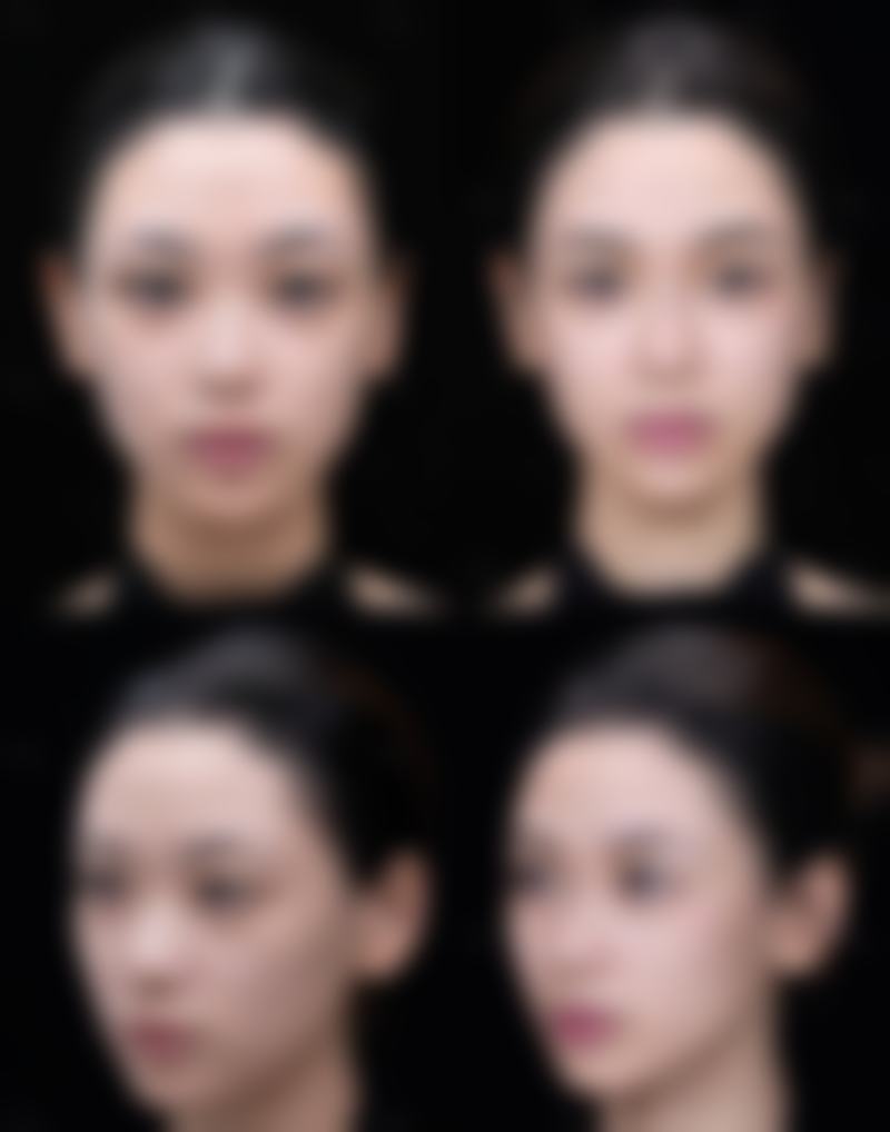 伤口愈合后1个月内(炎症期)修复情况怎样?