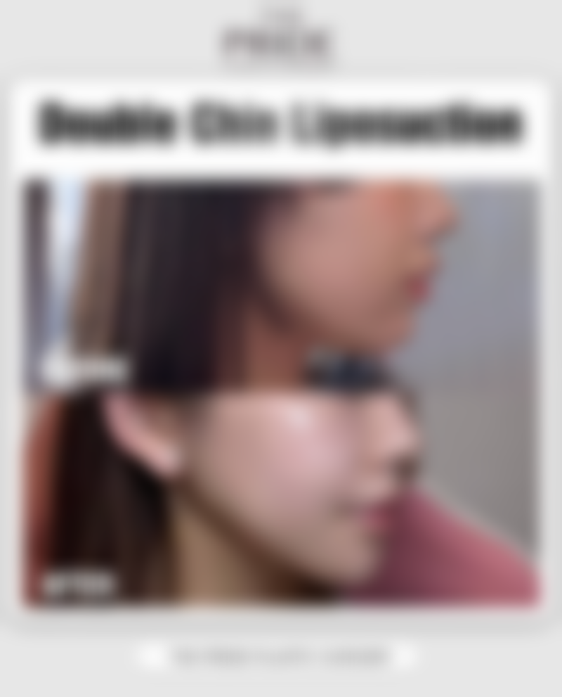 美莱医院做双眼皮成效怎么样?