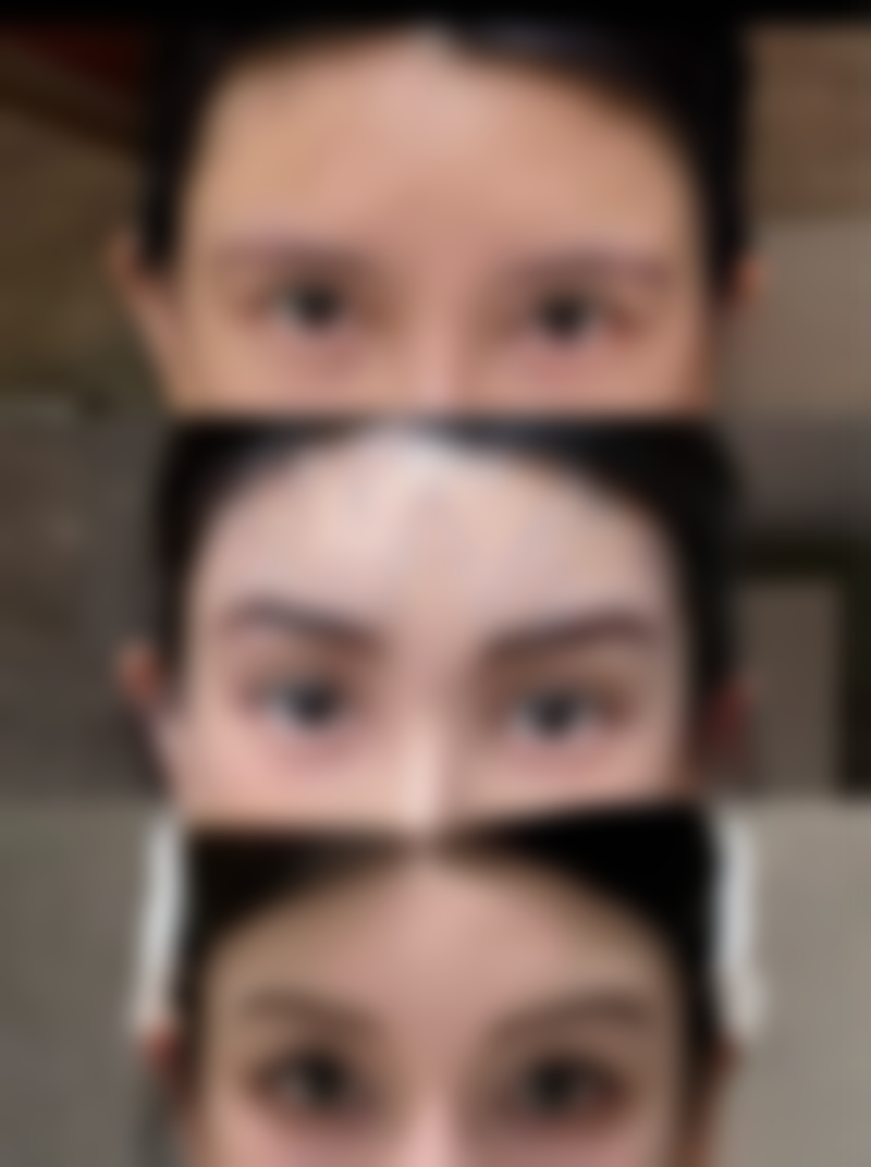 打了瘦脸针没成效该怎么办?