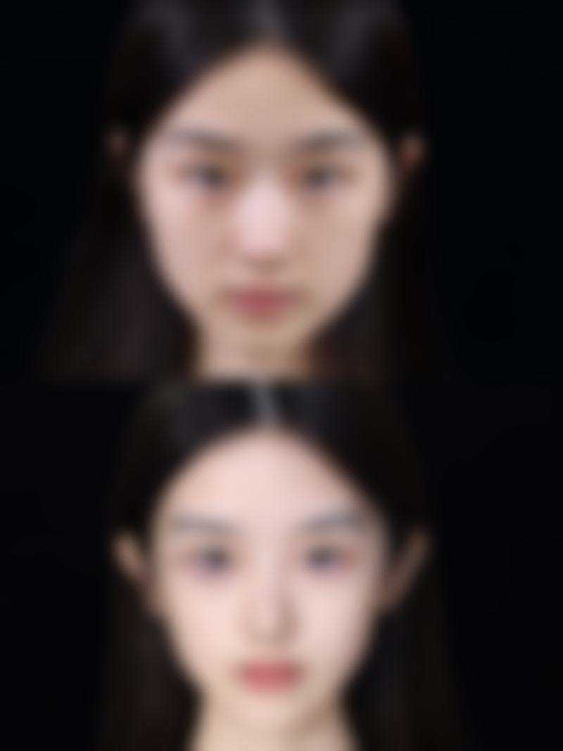 注射瘦脸针有什么副作用？会导致面部僵硬、咀嚼无力和效果不持久等情况吗？ 