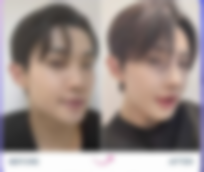 如果疤痕体质做双眼皮留疤了怎么办？