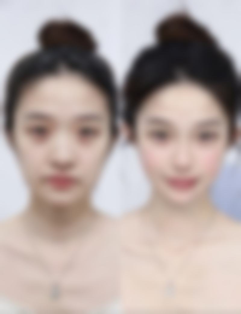 能分享一个37岁做双眼皮修复好的实例吗?