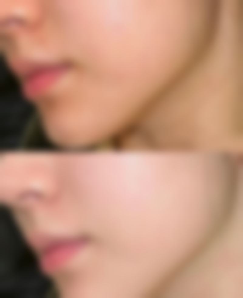 选择正规医院对37岁做双眼皮修复有什么重要性?