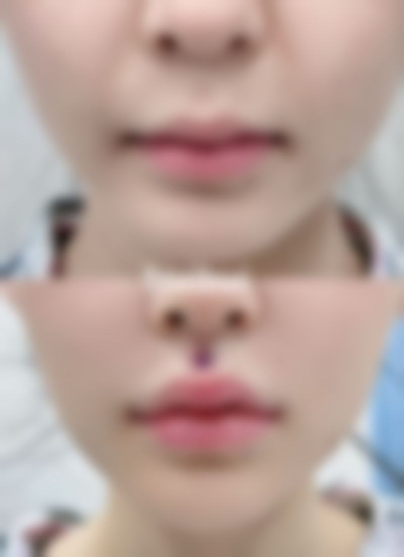 肋软骨鼻综合手术又要多久呢？