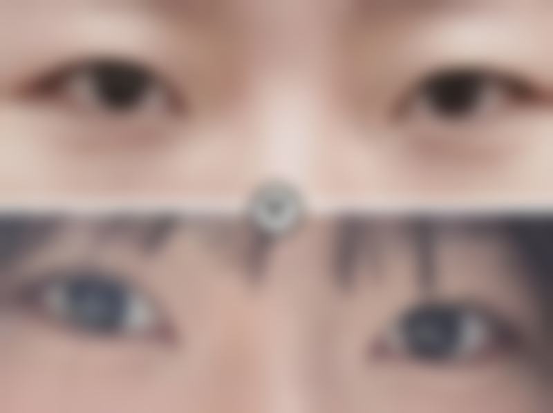 打瘦脸针多久会有效果？一般一周左右初见端倪，一个月左右效果较为明显 