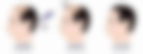 生活习惯对内切眼袋成效维持时间有什么影响？