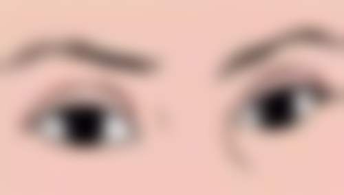 为什么说内切眼袋成效维持时间因人而异？