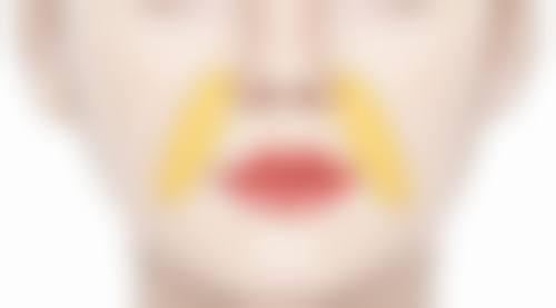 哪些人做双眼皮后需要擦祛疤膏呢？