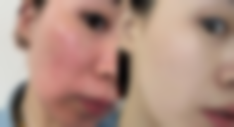 割双眼皮手术的主要影响因素是什么?和运气有关吗?