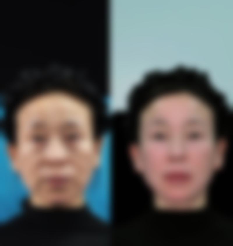 内切眼袋能完全阻止后续因衰老导致的皮肤松弛或脂肪膨出吗？