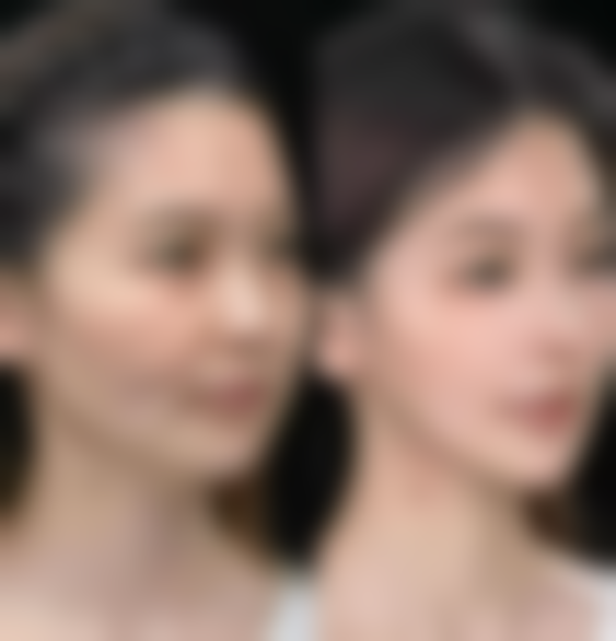 先天结构不对称会让双眼皮一个深一个浅吗？