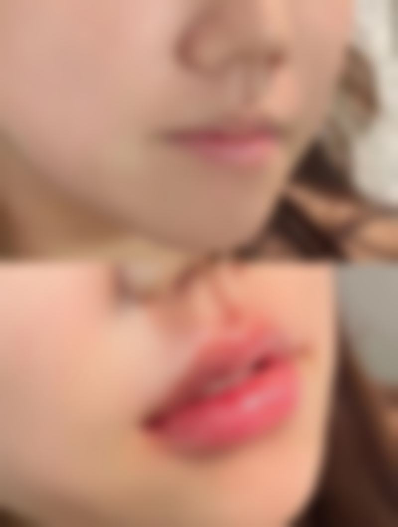 手术操作精细度会导致双眼皮一个深一个浅吗？