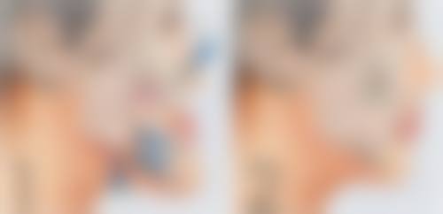 夏天做埋线双眼皮和其他季节做，成效会有差异吗？