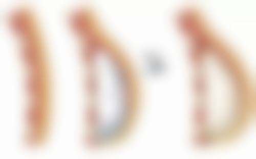 对于轻度眼袋，水光针能起到什么作用呢？