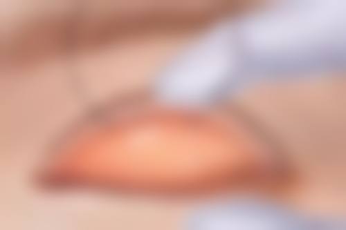 硅胶、膨体、盐水袋各有啥优势？