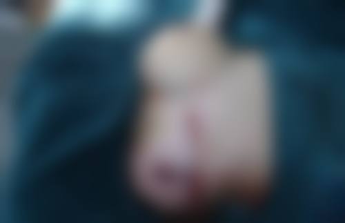 哪种隆胸假体材料好？硅胶、膨体、盐水袋各有啥优势，该如何选择呢？ 