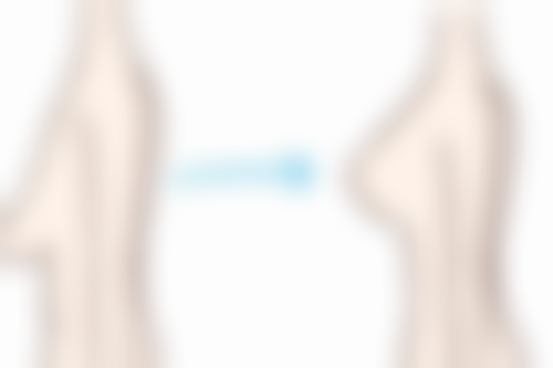 若眼袋长期存在且影响外观,该怎么做?