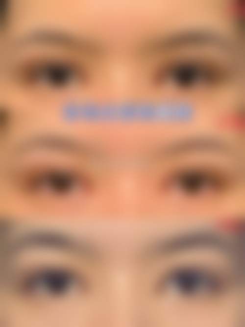 上海华澳整形美容医疗中 心邱梦玲医生眼部整形技术怎么样?