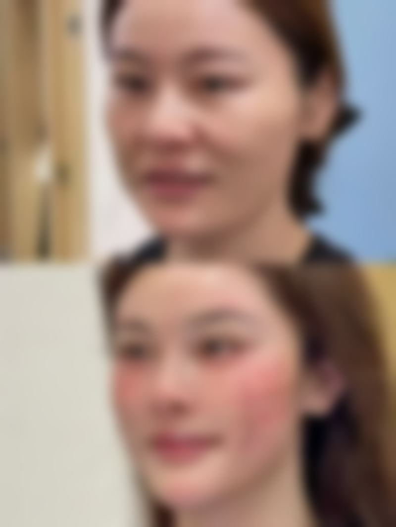 广州华美医院 [国内总部]对于去除脸上摔伤白色疤痕能提供哪些服务？