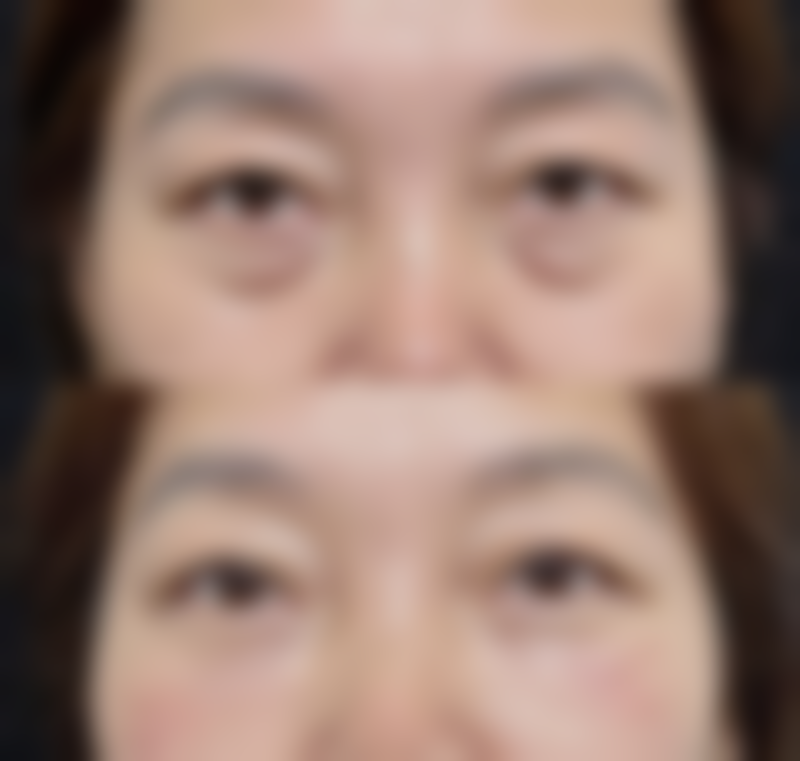 西安西 京医院整形外科彭湃医生面部脂肪填充技术怎么样?