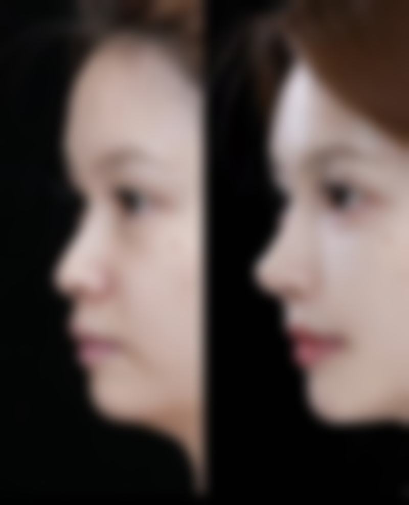 按摩对哪种类型的眼袋可能有成效?