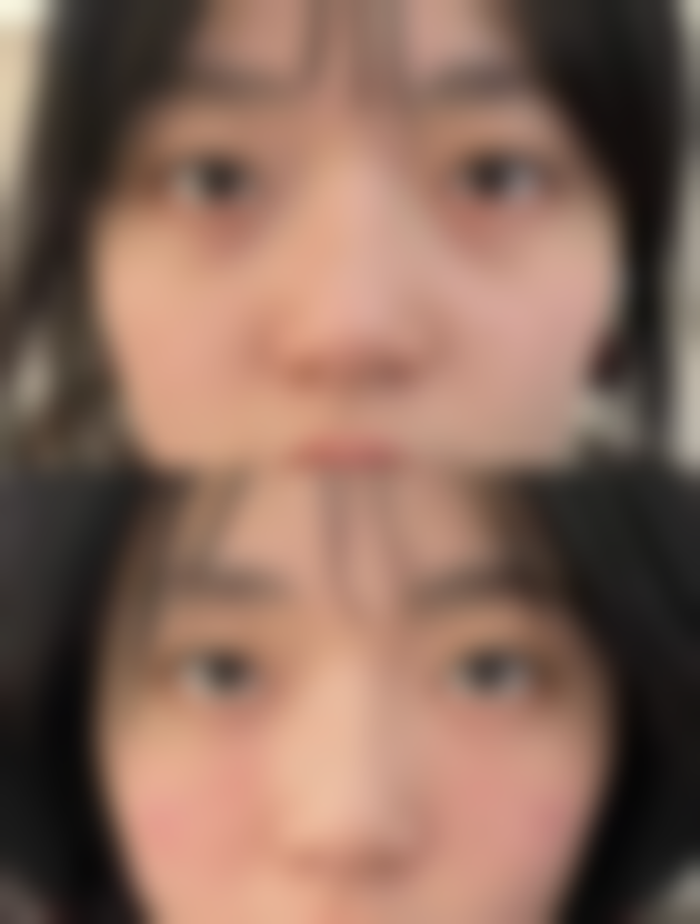 该如何选择隆胸假体材料？