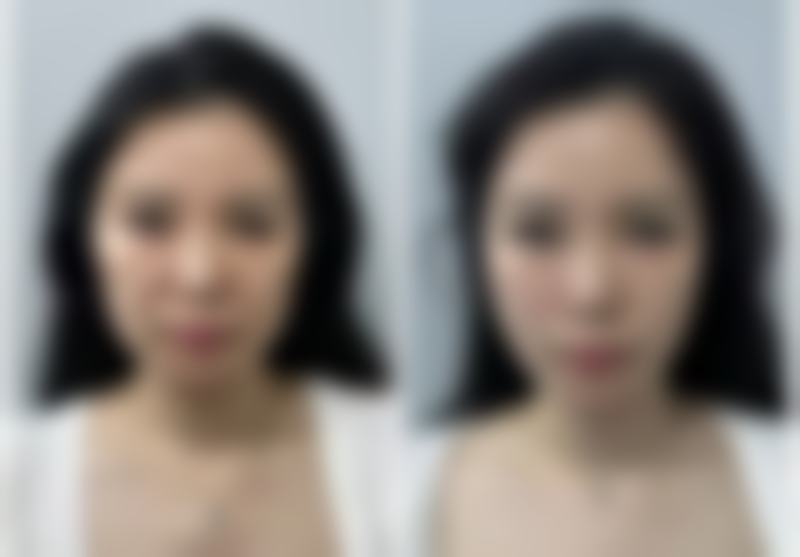 涂抹式水光针能祛除眼袋吗？