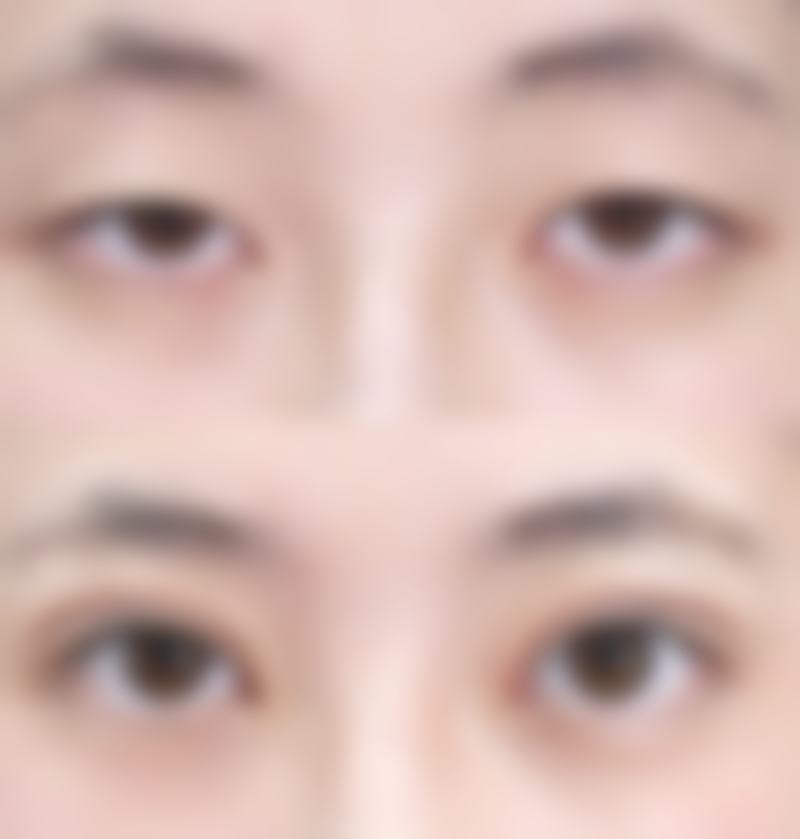 在去除脸上摔伤白色疤痕的过程中需要注意什么？