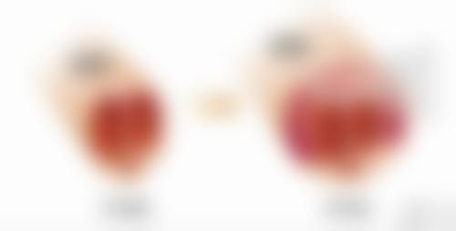 双眼皮切太宽了怎么办？能修复吗？修复方法有哪些及修复最佳时间是何时？ 