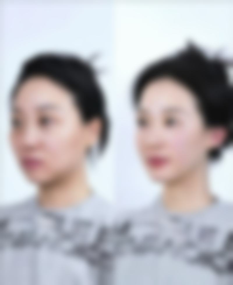 药物治疗疤痕疙瘩有哪些药物可用？