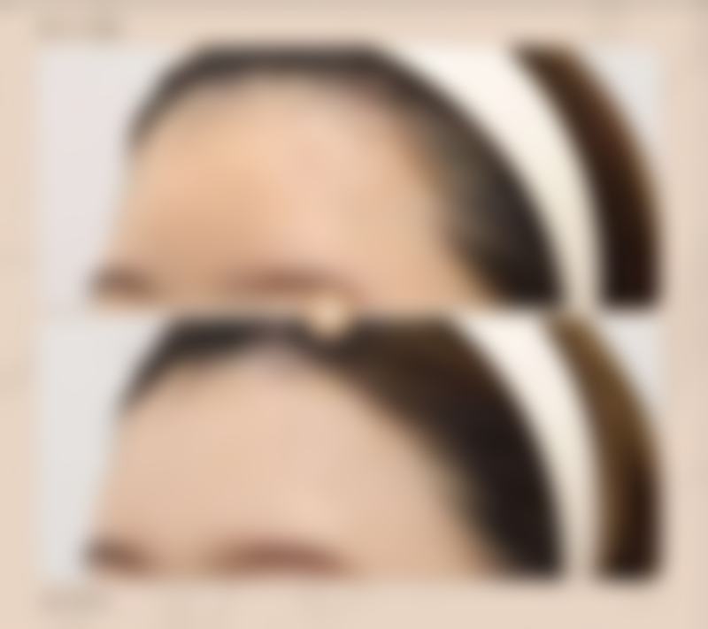 修复嘴唇疤痕疙瘩前需要做什么评估呢？