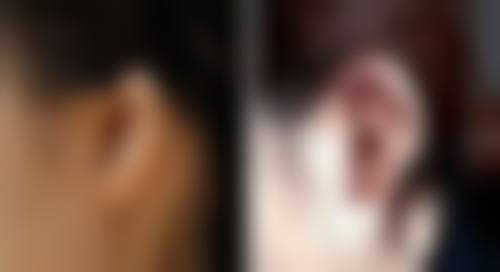 光子嫩肤能和瘦脸针一起做吗？答案是一般不建议，最好间隔一段时间分开进行！ 