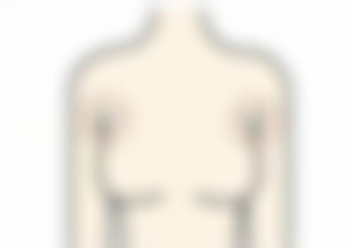 抽脂过量或手术技术不规范会造成什么影响？