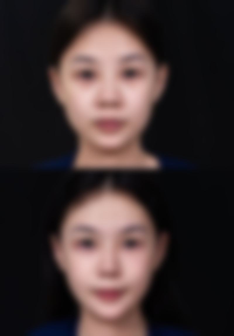 药物及填充治疗有哪些方法？使用时要注意什么？