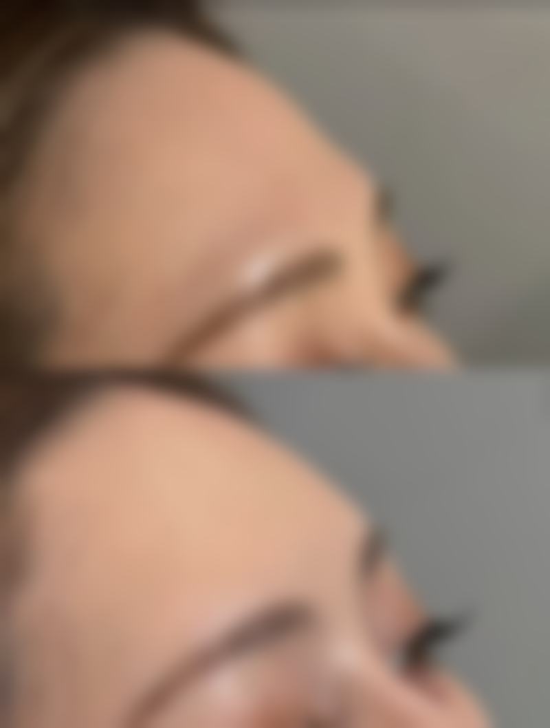 割双眼皮眼睛是不是会变大？答案是肯定的，它能从视觉上有效放大双眼！ 