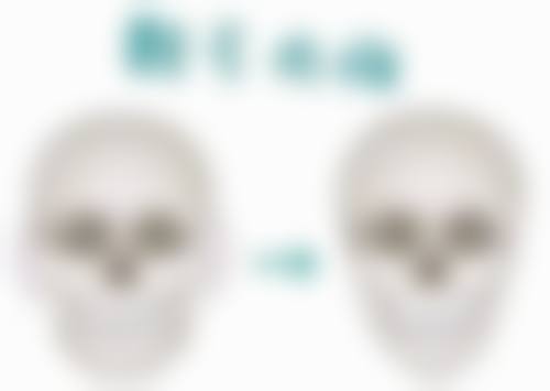 共振下颌吸脂术有什么优势？