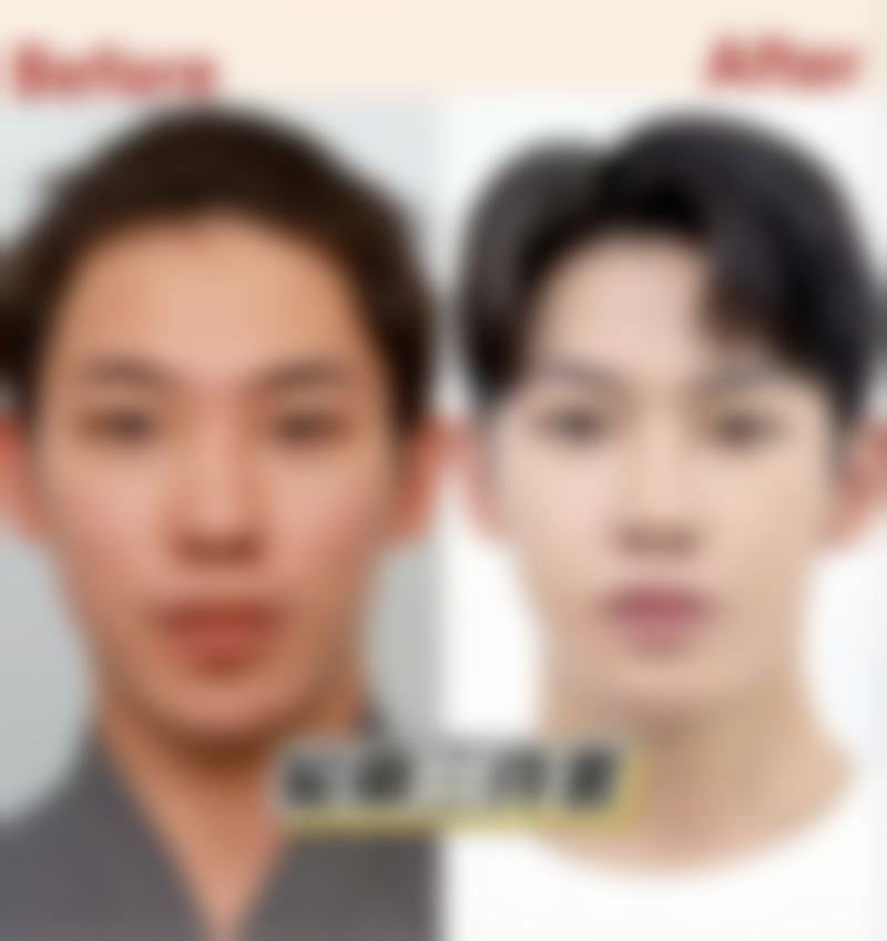 如果吸脂成效不理想怎么办？