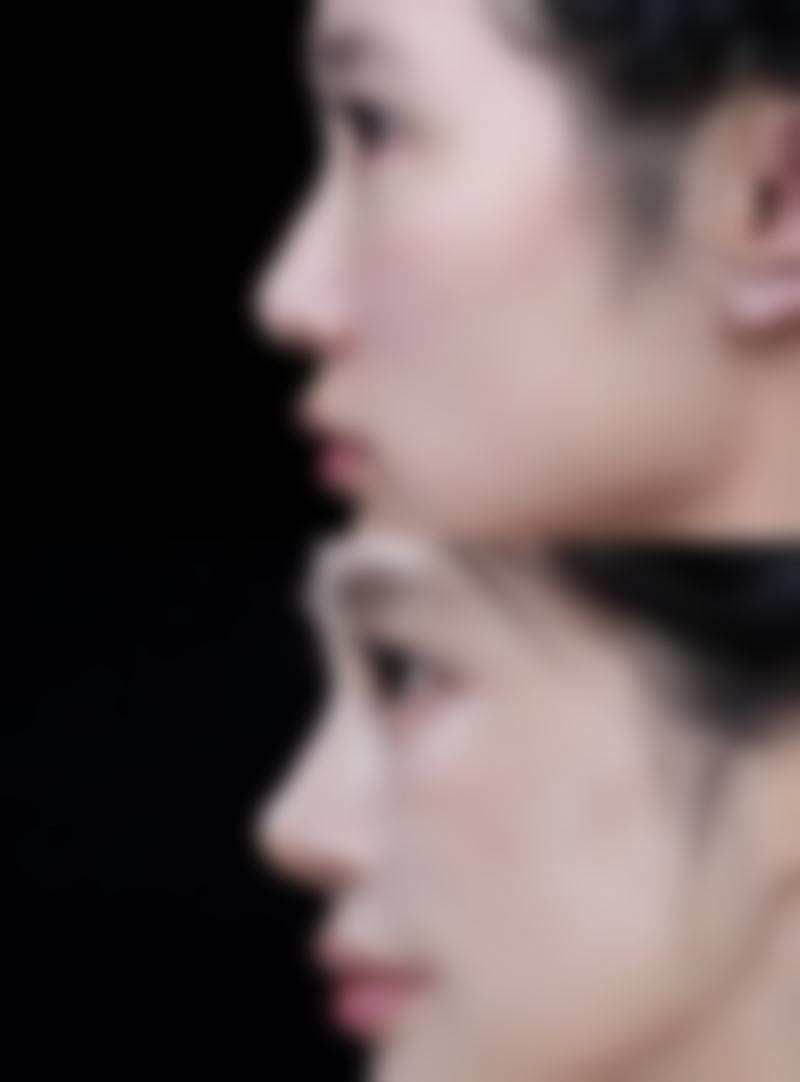 下巴吸脂的成效能持久吗？