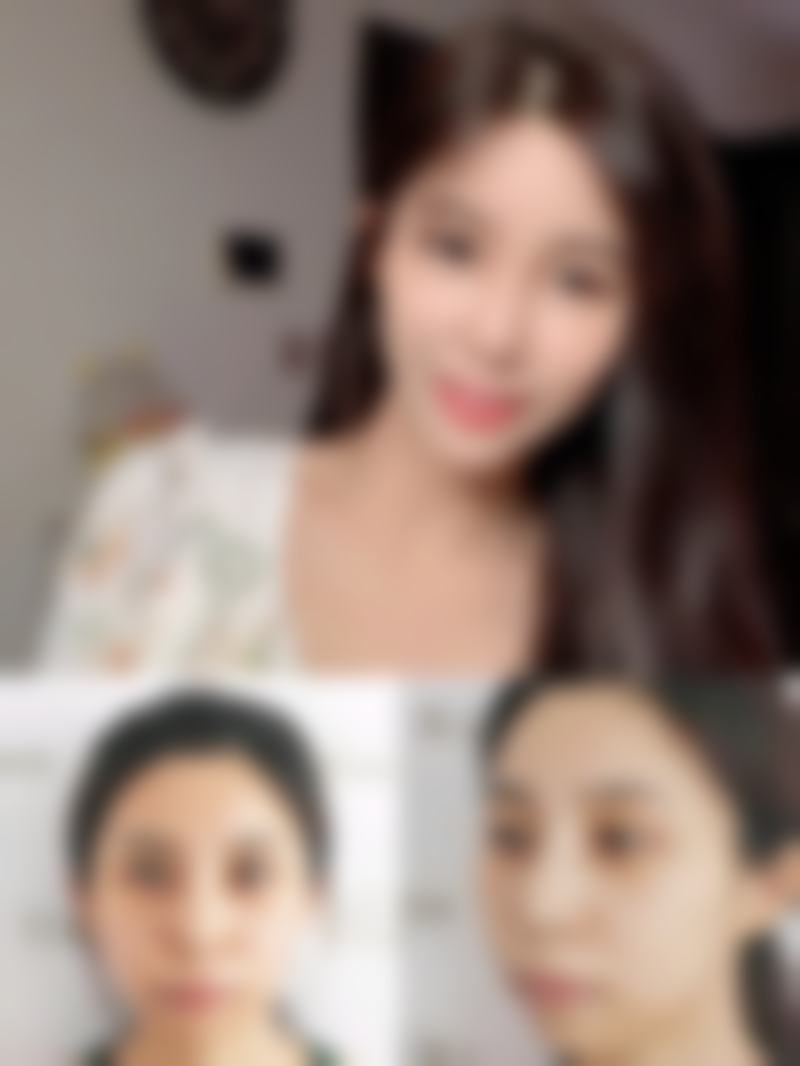 痤疮凹凸疤痕修复有哪些注意事项?