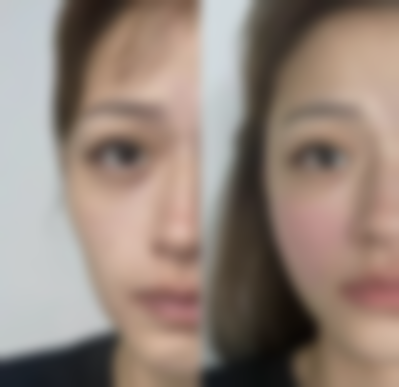 痤疮凹凸疤痕如何修复？激光治疗、微晶磨皮等方法能否助你重拾光滑肌肤？ 