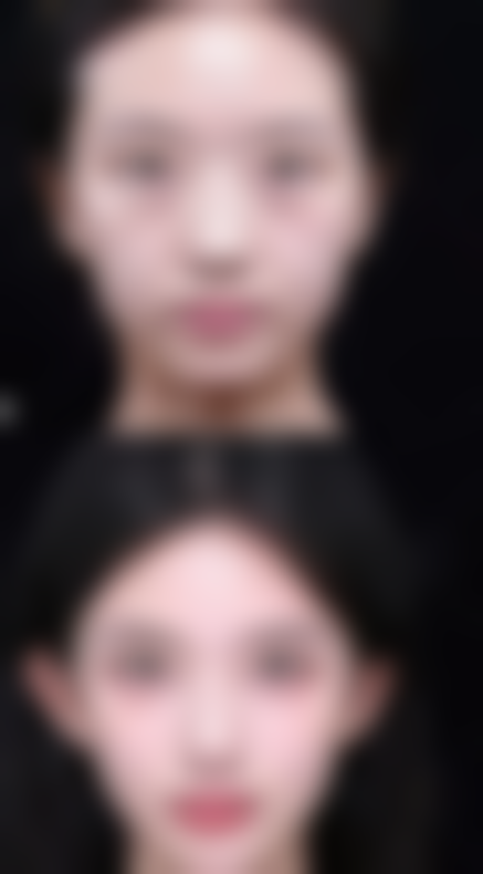 无锡第三人民医院烧伤整形科黄崇根医生疤痕修复技术怎么样？