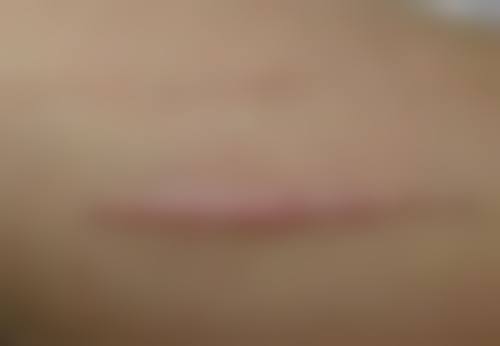 物理疗法能消除疤痕疙瘩吗？