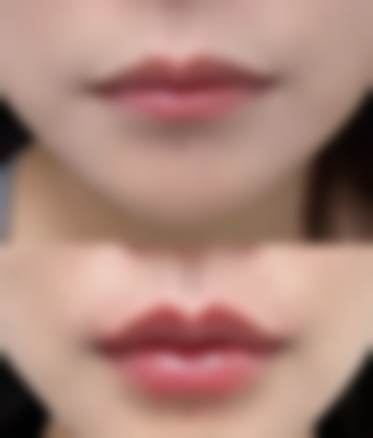 术后修复期有哪些替代方案？