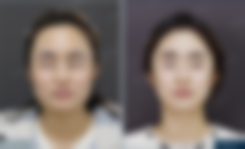 北京圣嘉新医疗美容医院25岁姑娘下颌角方盒感改善案例分享：复合方案效果超棒！ 