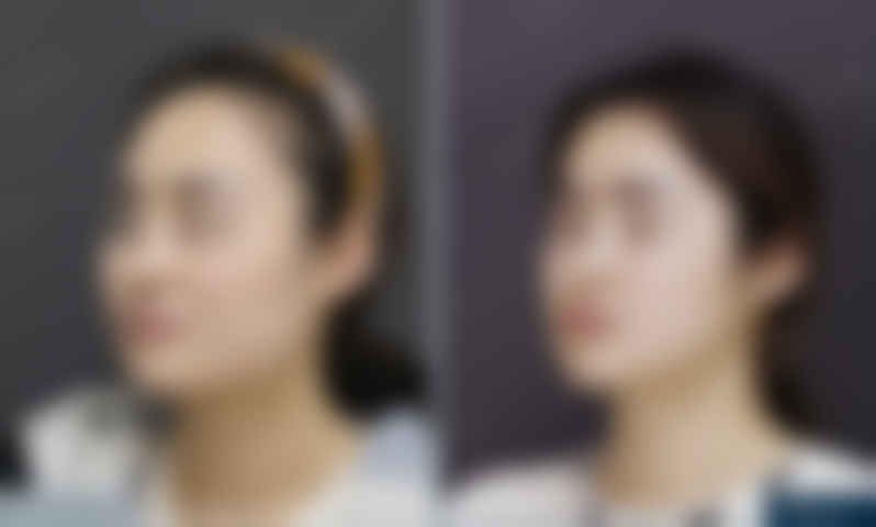 北京圣嘉新医疗美容医院手术过程到底咋样呢？