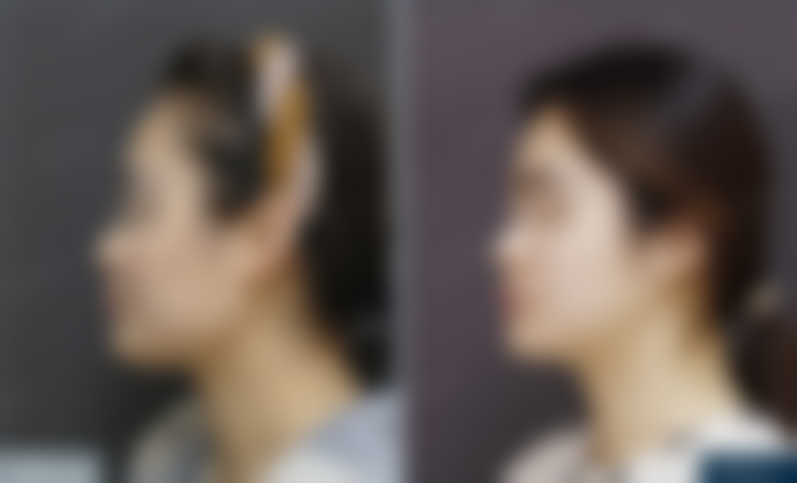 北京圣嘉新医疗美容医院一年后复查成效咋样呢？