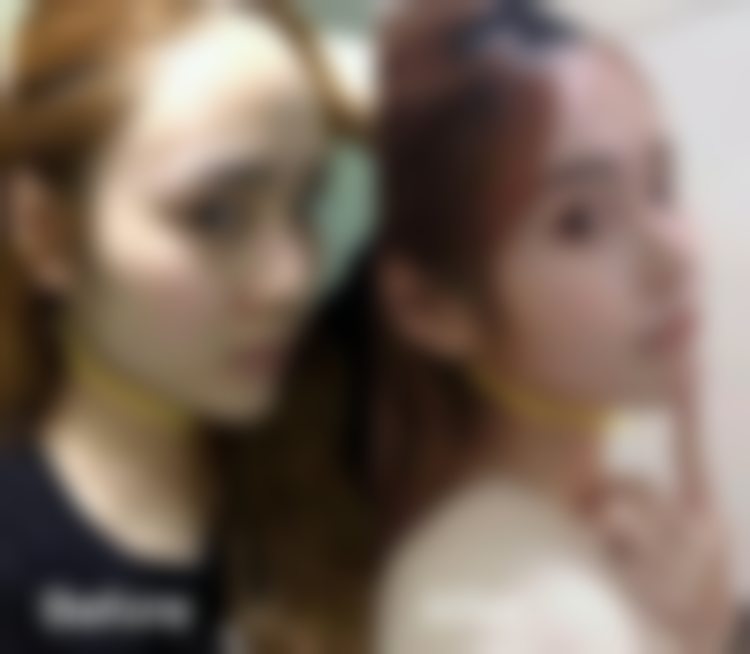 杭州连天美医疗美容医院方脸矫正术太牛哇，术后成效真的能达预期吗？