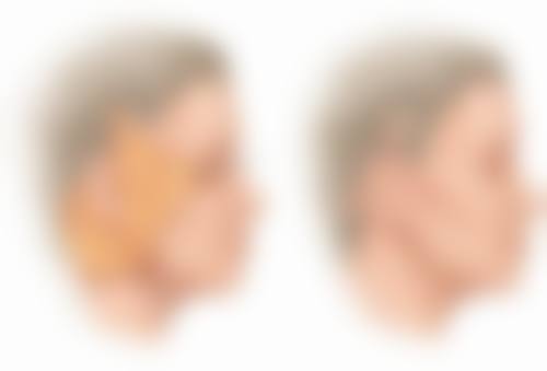 厦门174医院整形美容科阮南杰医生面部除皱技术怎么样？