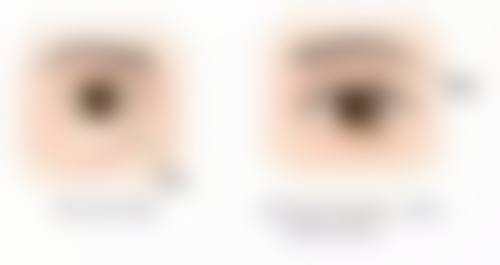 瘦脸针会对面部表情产生什么问题呢？