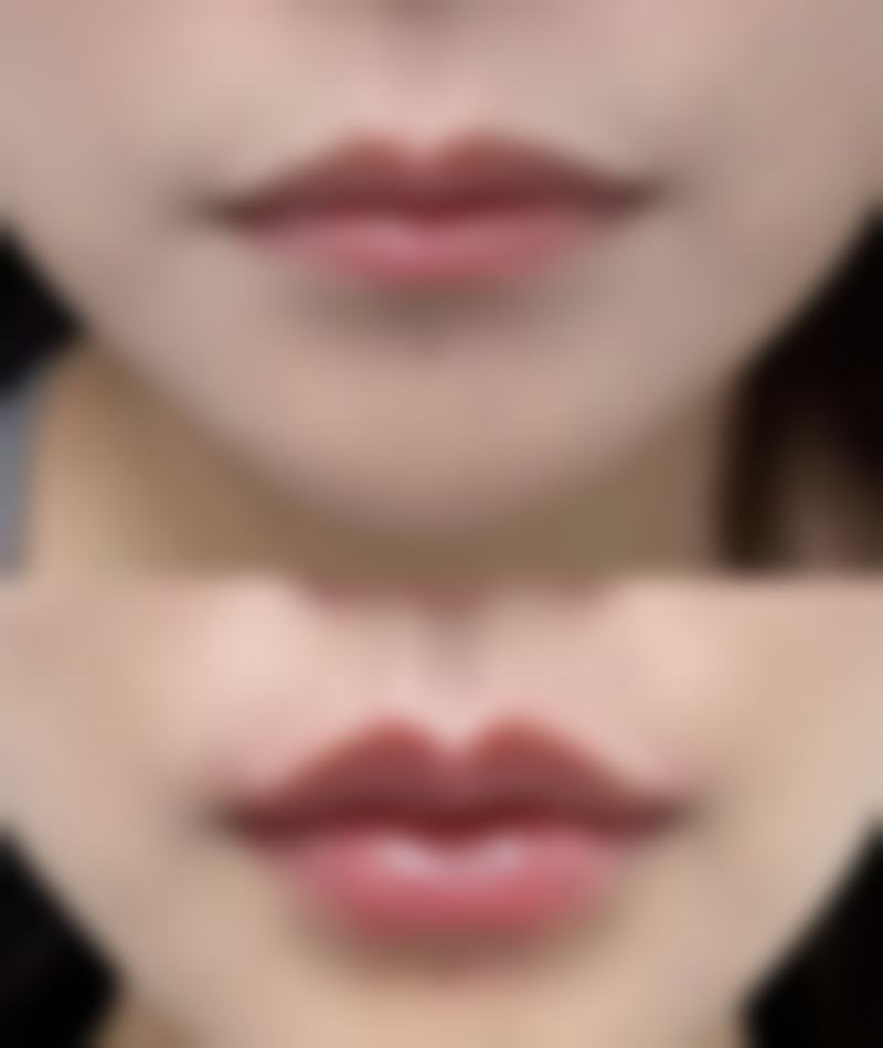 打完瘦脸针有什么副作用？会导致面部僵硬、咀嚼无力，还会有过敏反应吗？ 